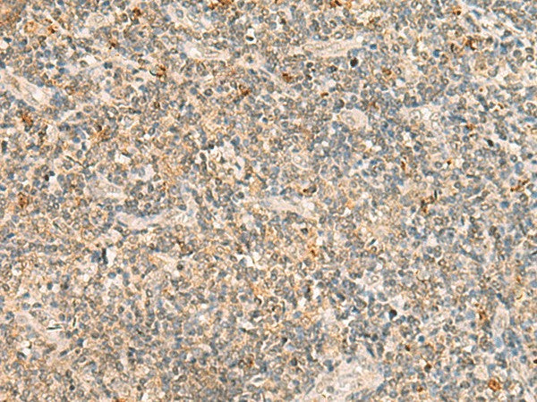 Immunohistochemistry of paraffin-embedded Human tonsil tissue using TBCK Polyclonal Antibody at dilution of 1:25(×200)