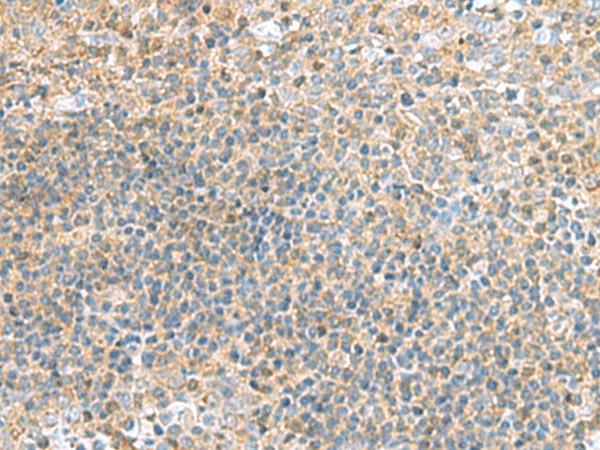 Immunohistochemistry of paraffin-embedded Human tonsil tissue using TSTA3 Polyclonal Antibody at dilution of 1:45(×200)
