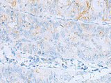 Immunohistochemistry of paraffin-embedded Human colorectal cancer tissue using ERBB2 Polyclonal Antibody at dilution of 1:60(×200)