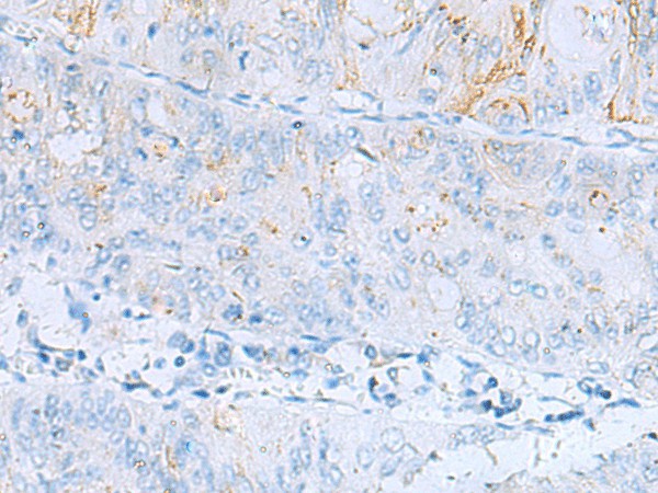 Immunohistochemistry of paraffin-embedded Human colorectal cancer tissue using ERBB2 Polyclonal Antibody at dilution of 1:60(×200)