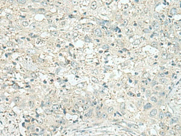 Immunohistochemistry of paraffin-embedded Human esophagus cancer tissue using DENND6A Polyclonal Antibody at dilution of 1:120(×200)