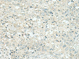 Immunohistochemistry of paraffin-embedded Human esophagus cancer tissue using DENND6A Polyclonal Antibody at dilution of 1:120(×200)