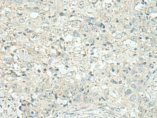 Immunohistochemistry of paraffin-embedded Human esophagus cancer tissue using DENND6A Polyclonal Antibody at dilution of 1:120(×200)