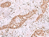 Immunohistochemistry of paraffin-embedded Human esophagus cancer tissue using ISL2 Polyclonal Antibody at dilution of 1:40(×200)