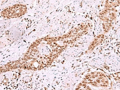 Immunohistochemistry of paraffin-embedded Human esophagus cancer tissue using ISL2 Polyclonal Antibody at dilution of 1:40(×200)