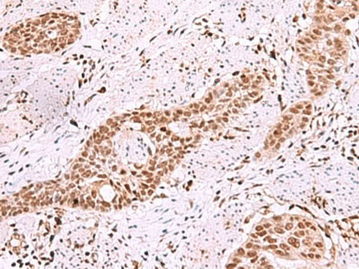 Immunohistochemistry of paraffin-embedded Human esophagus cancer tissue using ISL2 Polyclonal Antibody at dilution of 1:40(×200)