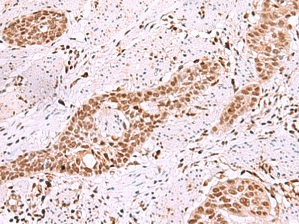 Immunohistochemistry of paraffin-embedded Human esophagus cancer tissue using ISL2 Polyclonal Antibody at dilution of 1:40(×200)