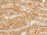 Immunohistochemistry of paraffin-embedded Human thyroid cancer tissue using C3orf38 Polyclonal Antibody at dilution of 1:80(×200)