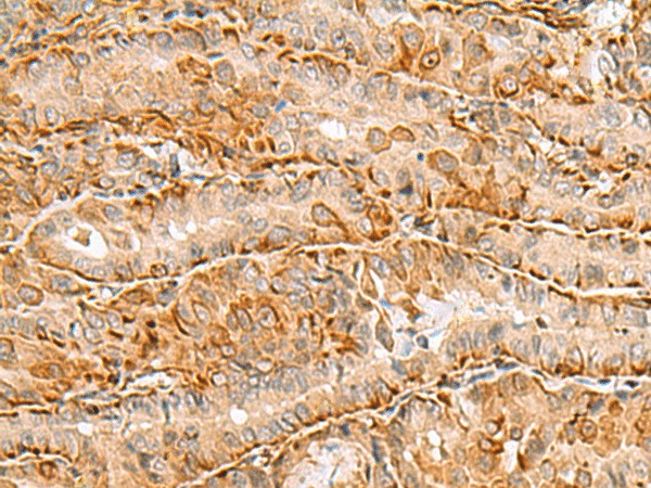Immunohistochemistry of paraffin-embedded Human thyroid cancer tissue using C3orf38 Polyclonal Antibody at dilution of 1:80(×200)