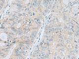 Immunohistochemistry of paraffin-embedded Human colorectal cancer tissue using APOBR Polyclonal Antibody at dilution of 1:35(×200)