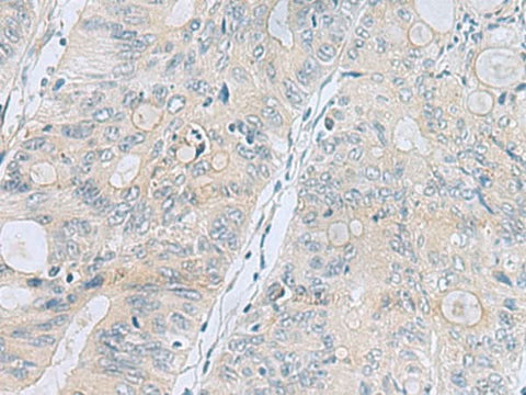 Immunohistochemistry of paraffin-embedded Human colorectal cancer tissue using APOBR Polyclonal Antibody at dilution of 1:35(×200)