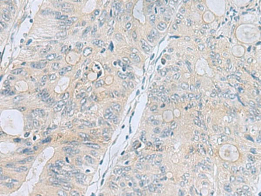 Immunohistochemistry of paraffin-embedded Human colorectal cancer tissue using APOBR Polyclonal Antibody at dilution of 1:35(×200)