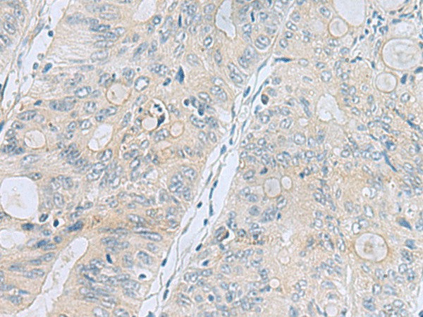 Immunohistochemistry of paraffin-embedded Human colorectal cancer tissue using APOBR Polyclonal Antibody at dilution of 1:35(×200)