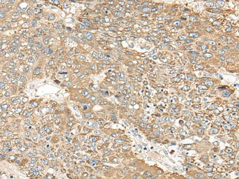 Immunohistochemistry of paraffin-embedded Human liver cancer tissue using C1orf101 Polyclonal Antibody at dilution of 1:65(×200)