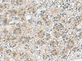Immunohistochemistry of paraffin-embedded Human liver cancer tissue using RAB39A Polyclonal Antibody at dilution of 1:70(×200)