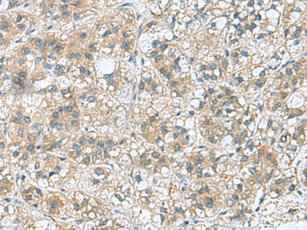 Immunohistochemistry of paraffin-embedded Human liver cancer tissue using RAB39A Polyclonal Antibody at dilution of 1:70(×200)