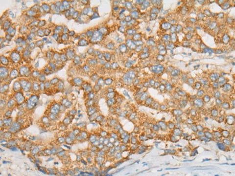Immunohistochemistry of paraffin-embedded Human liver cancer tissue using ATXN7 Polyclonal Antibody at dilution of 1:60(×200)