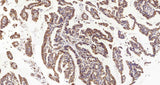 Immunohistochemistry analysis of paraffin-embedded human stomach cancer using HSPA5 Polyclonal Antibody at dilution of 1:300.
