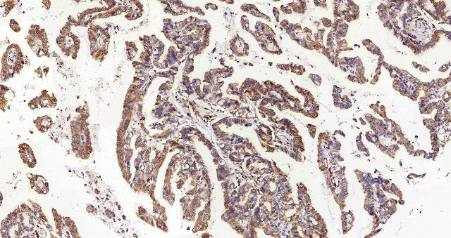 Immunohistochemistry analysis of paraffin-embedded human stomach cancer using HSPA5 Polyclonal Antibody at dilution of 1:300.