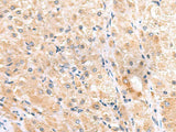 Immunohistochemistry of paraffin-embedded Human liver cancer tissue using ITGA3 Polyclonal Antibody at dilution of 1:45(×200)