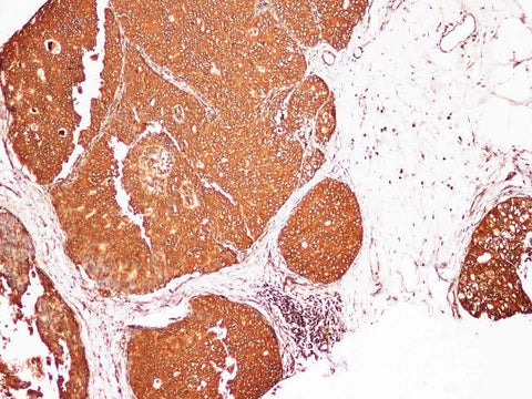 Immunohistochemistry of paraffin-embedded Human breast cancer using S100A9 Polyclonl Antibody at dilution of 1:200.