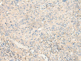 Immunohistochemistry of paraffin-embedded Human cervical cancer tissue using KCNA10 Polyclonal Antibody at dilution of 1:40(×200)