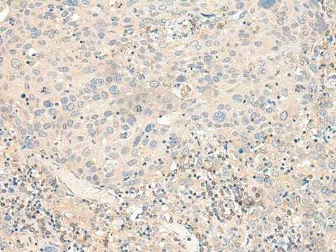 Immunohistochemistry of paraffin-embedded Human cervical cancer tissue using KCNA10 Polyclonal Antibody at dilution of 1:40(×200)