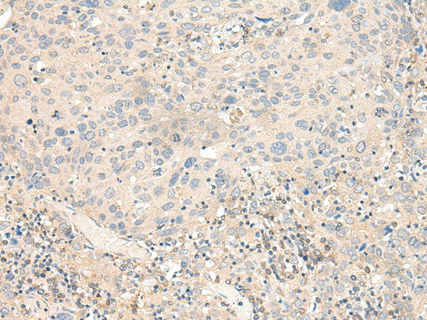 Immunohistochemistry of paraffin-embedded Human cervical cancer tissue using KCNA10 Polyclonal Antibody at dilution of 1:40(×200)
