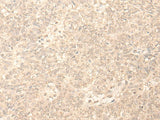 Immunohistochemistry of paraffin-embedded Human ovarian cancer tissue using PLEKHA1 Polyclonal Antibody at dilution of 1:30(×200)