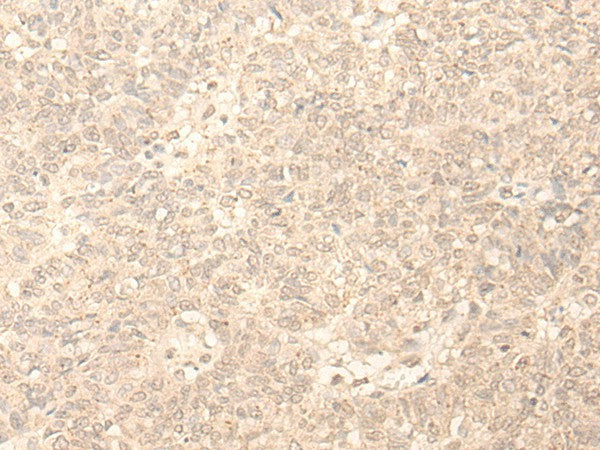 Immunohistochemistry of paraffin-embedded Human ovarian cancer tissue using PLEKHA1 Polyclonal Antibody at dilution of 1:30(×200)