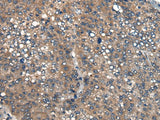 Immunohistochemistry of paraffin-embedded Human liver cancer tissue using ICMT Polyclonal Antibody at dilution of 1:45(×200)