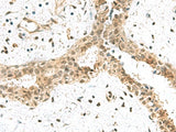 Immunohistochemistry of paraffin-embedded Human breast cancer tissue using ELOC Polyclonal Antibody at dilution of 1:55(×200)
