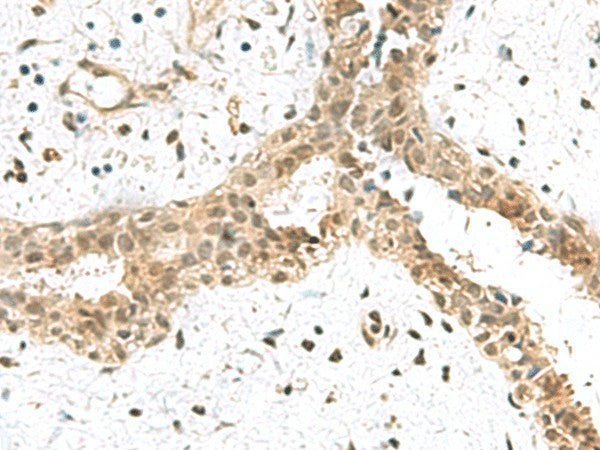 Immunohistochemistry of paraffin-embedded Human breast cancer tissue using ELOC Polyclonal Antibody at dilution of 1:55(×200)