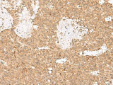 Immunohistochemistry of paraffin-embedded Human ovarian cancer tissue using LGALSL Polyclonal Antibody at dilution of 1:25(×200)