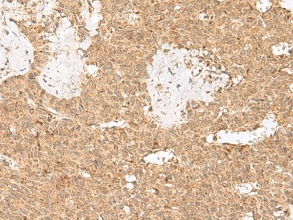 Immunohistochemistry of paraffin-embedded Human ovarian cancer tissue using LGALSL Polyclonal Antibody at dilution of 1:25(×200)