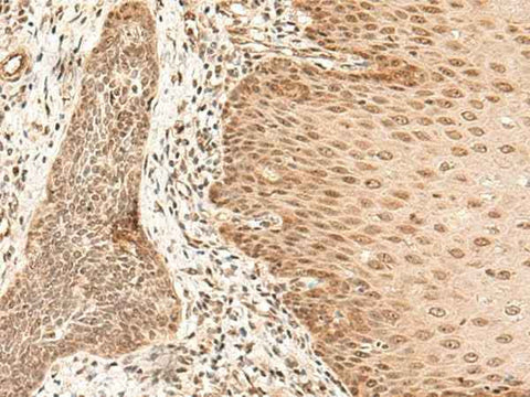 Immunohistochemistry of paraffin-embedded Human esophagus cancer tissue using ARMC8 Polyclonal Antibody at dilution of 1:40(×200)