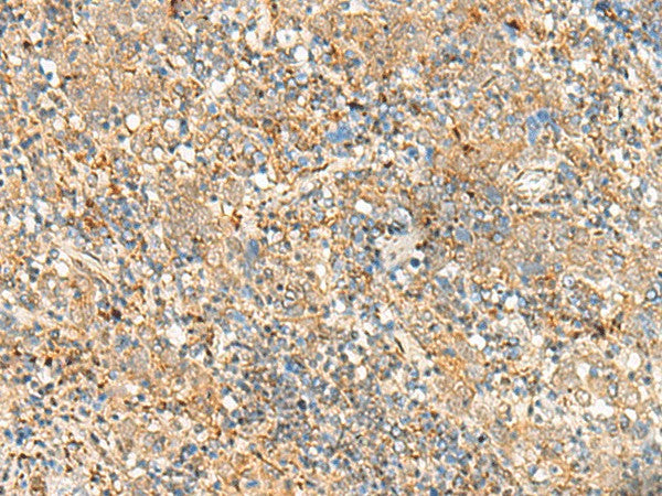 Immunohistochemistry of paraffin-embedded Human cervical cancer tissue using FKBP1A Polyclonal Antibody at dilution of 1:55(×200)