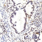 Immunohistochemistry analysis of paraffin-embedded human lung cancer using p27 Polyclonal Antibody at dilution of 1:400.