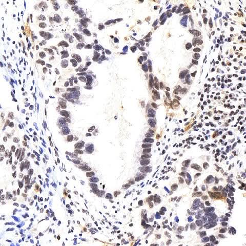 Immunohistochemistry analysis of paraffin-embedded human lung cancer using p27 Polyclonal Antibody at dilution of 1:400.