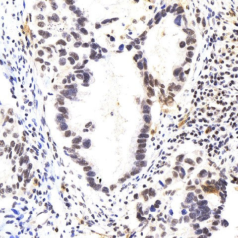 Immunohistochemistry analysis of paraffin-embedded human lung cancer using p27 Polyclonal Antibody at dilution of 1:400.