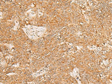 Immunohistochemistry of paraffin-embedded Human ovarian cancer tissue using PDCD4 Polyclonal Antibody at dilution of 1:35(×200)