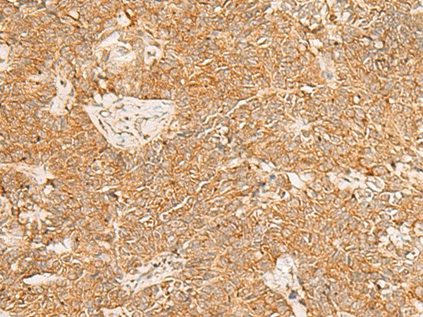 Immunohistochemistry of paraffin-embedded Human ovarian cancer tissue using PDCD4 Polyclonal Antibody at dilution of 1:35(×200)