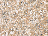 Immunohistochemistry of paraffin-embedded Human liver cancer tissue using PTPRS Polyclonal Antibody at dilution of 1:110(×200)