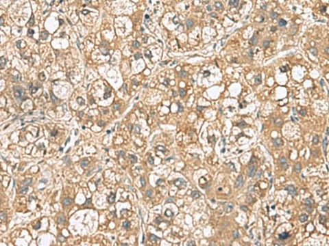 Immunohistochemistry of paraffin-embedded Human liver cancer tissue using PTPRS Polyclonal Antibody at dilution of 1:110(×200)