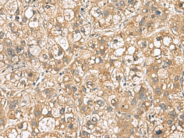Immunohistochemistry of paraffin-embedded Human liver cancer tissue using PTPRS Polyclonal Antibody at dilution of 1:110(×200)