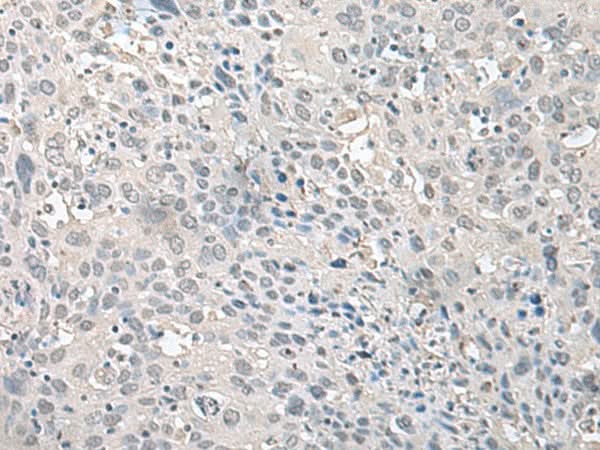 Immunohistochemistry of paraffin-embedded Human cervical cancer tissue using EPM2A Polyclonal Antibody at dilution of 1:75(×200)