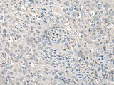 Immunohistochemistry of paraffin-embedded Human cervical cancer tissue using EPM2A Polyclonal Antibody at dilution of 1:75(×200)
