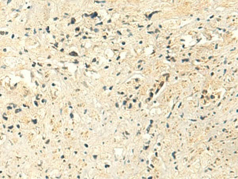 Immunohistochemistry of paraffin-embedded Human prost at e cancer tissue using MTHFS Polyclonal Antibody at dilution of 1:50(×200)