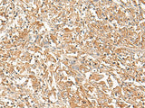 Immunohistochemistry of paraffin-embedded Human liver cancer tissue using CORO2A Polyclonal Antibody at dilution of 1:50(×200)