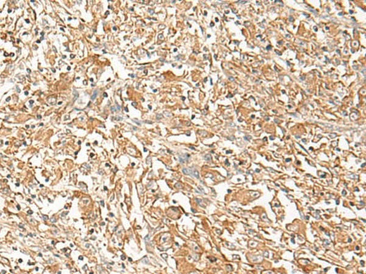 Immunohistochemistry of paraffin-embedded Human liver cancer tissue using CORO2A Polyclonal Antibody at dilution of 1:50(×200)